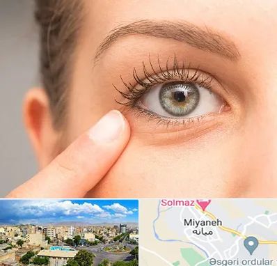 جراح پف چشم در میانه