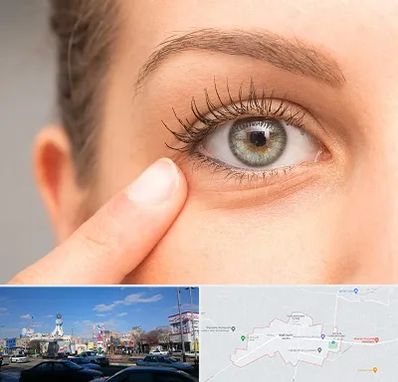 جراح پف چشم در ماهدشت کرج 