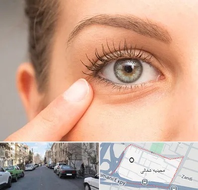 جراح پف چشم در مجیدیه شمالی