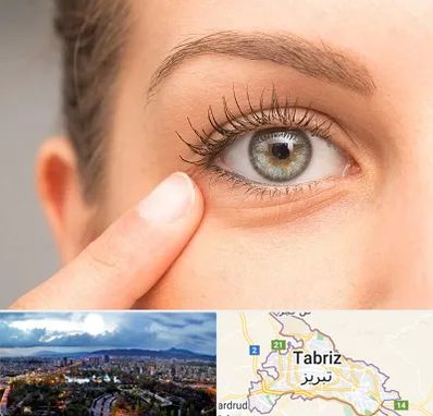 جراح پف چشم در تبریز