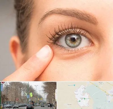 جراح پف چشم در نظرآباد کرج 