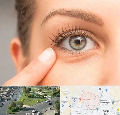 جراح پف چشم در شاهین ویلا کرج