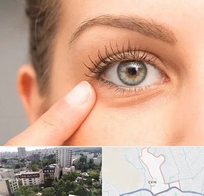 جراح پف چشم در اوین