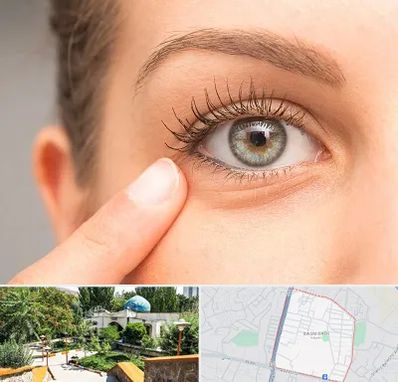 جراح پف چشم در باغمیشه تبریز