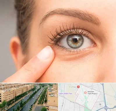 جراح پف چشم در فاز سه اندیشه