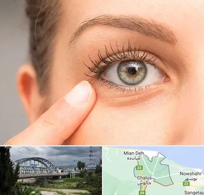 جراح پف چشم در چالوس