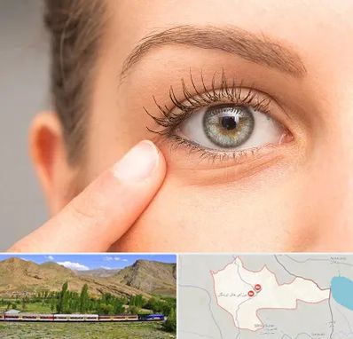 جراح پف چشم در خاش