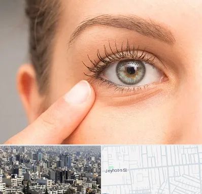جراح پف چشم در جیحون