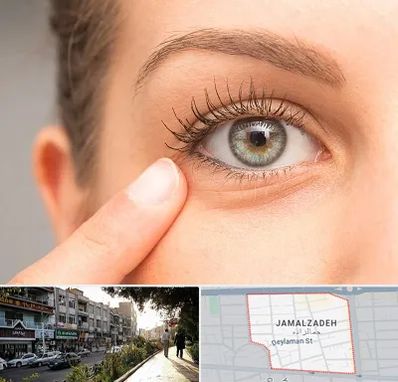 جراح پف چشم در خیابان جمالزاده