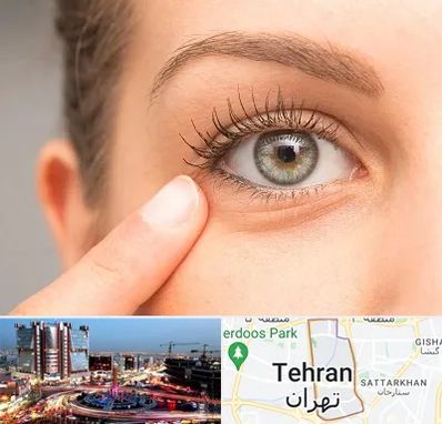 جراح پف چشم در صادقیه 