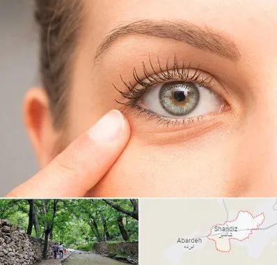 جراح پف چشم در شاندیز مشهد