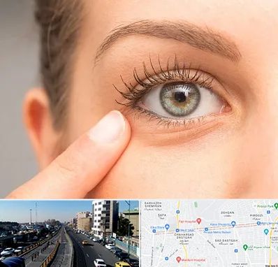 جراح پف چشم در پیروزی 