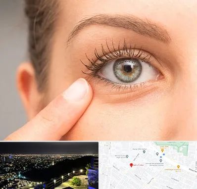 جراح پف چشم در هفت تیر مشهد 