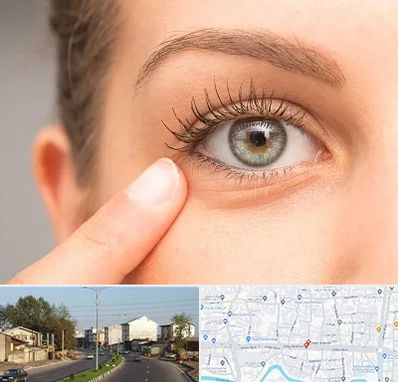 جراح پف چشم در ضیابری رشت