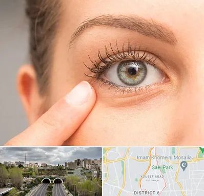 جراح پف چشم در یوسف آباد 