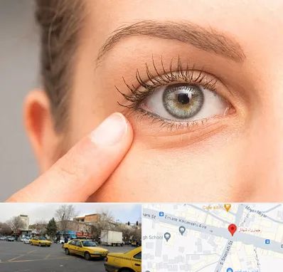 جراح پف چشم در شهناز تبریز