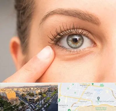 جراح پف چشم در تهرانپارس 