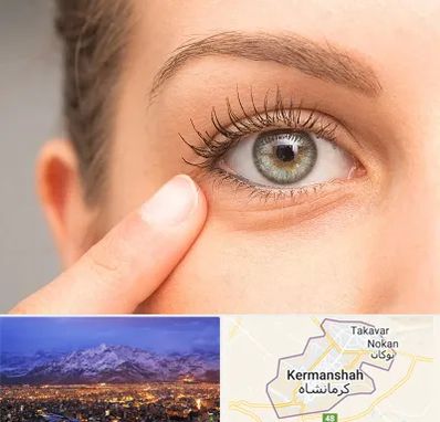 جراح پف چشم در کرمانشاه