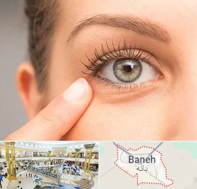 جراح پف چشم در بانه