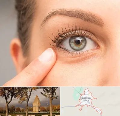 جراح پف چشم در تویسرکان