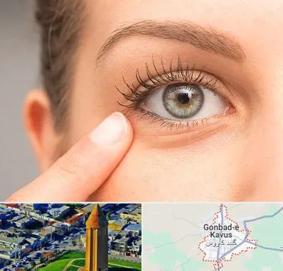 جراح پف چشم در گنبد کاووس