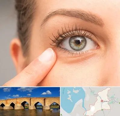 جراح پف چشم در بناب