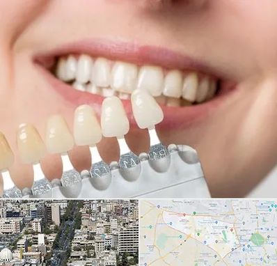 مرکز کامپوزیت دندان در منطقه 18 تهران