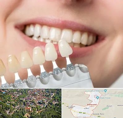 مرکز کامپوزیت دندان در دماوند