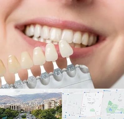 مرکز کامپوزیت دندان در خانی آباد