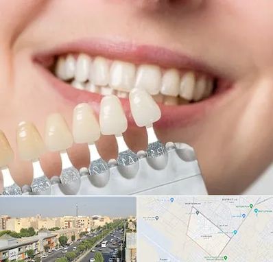 مرکز کامپوزیت دندان در کیانمهر کرج