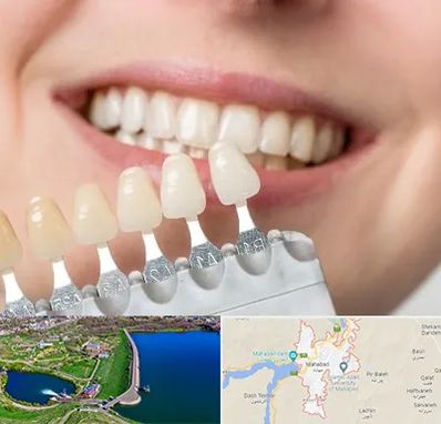 مرکز کامپوزیت دندان در مهاباد
