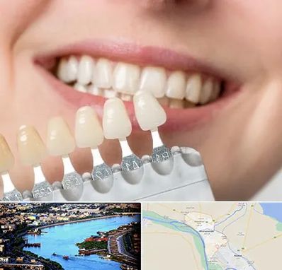 مرکز کامپوزیت دندان در خرمشهر