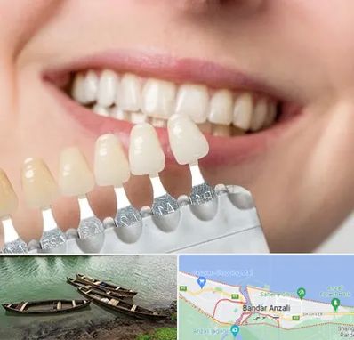مرکز کامپوزیت دندان در بندر انزلی