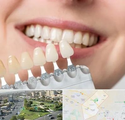 مرکز کامپوزیت دندان در کمال شهر کرج