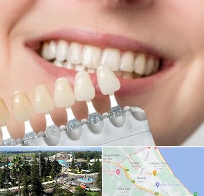 مرکز کامپوزیت دندان در رودسر