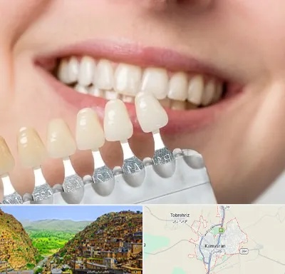 مرکز کامپوزیت دندان در کامیاران