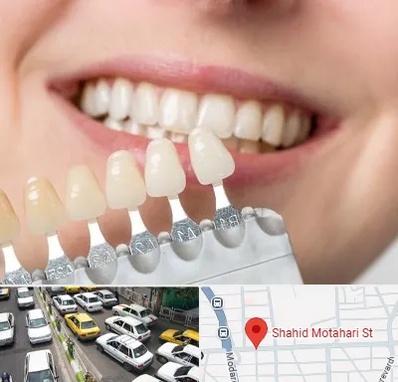 مرکز کامپوزیت دندان در مطهری تهران
