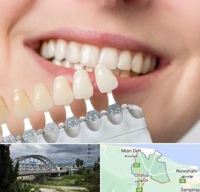 مرکز کامپوزیت دندان در چالوس