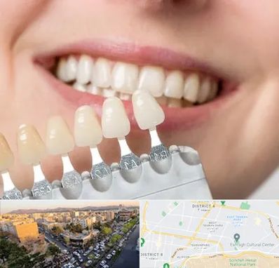 مرکز کامپوزیت دندان در تهرانپارس