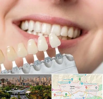 مرکز کامپوزیت دندان در منطقه 1 تهران