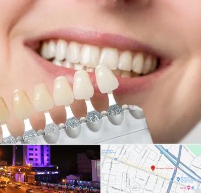 مرکز کامپوزیت دندان در آبرسان تبریز