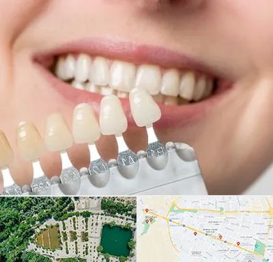 مرکز کامپوزیت دندان در وکیل آباد مشهد