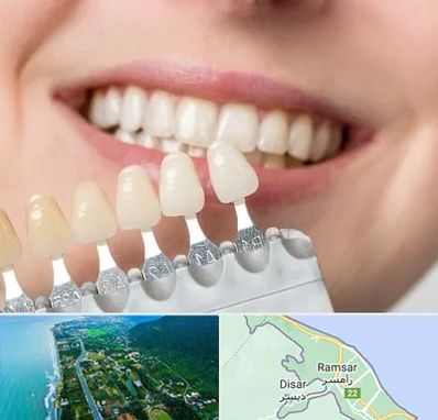 مرکز کامپوزیت دندان در رامسر