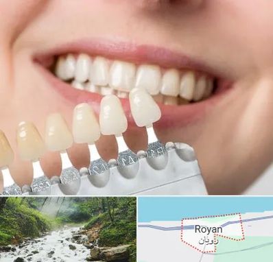 مرکز کامپوزیت دندان در رویان