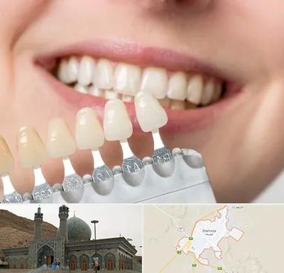 مرکز کامپوزیت دندان در شهرضا