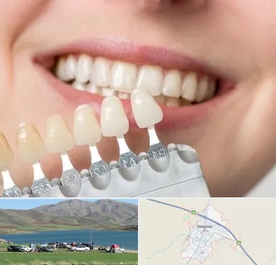 مرکز کامپوزیت دندان در دهگلان