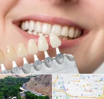 مرکز کامپوزیت دندان در کن