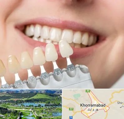 مرکز کامپوزیت دندان در خرم آباد