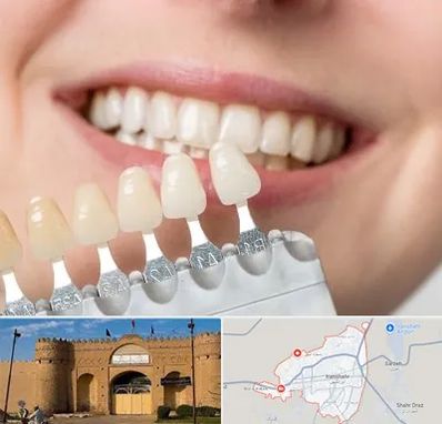 مرکز کامپوزیت دندان در ایرانشهر