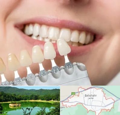 مرکز کامپوزیت دندان در بهشهر